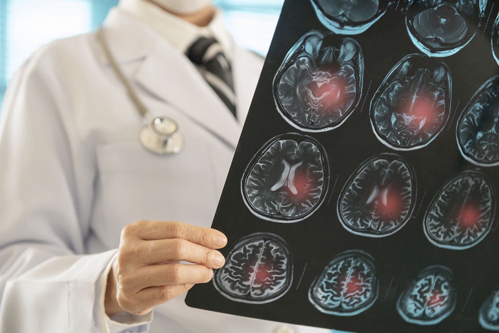 Врач рассматривает снимок головного мозга, подозрение на инсульт.