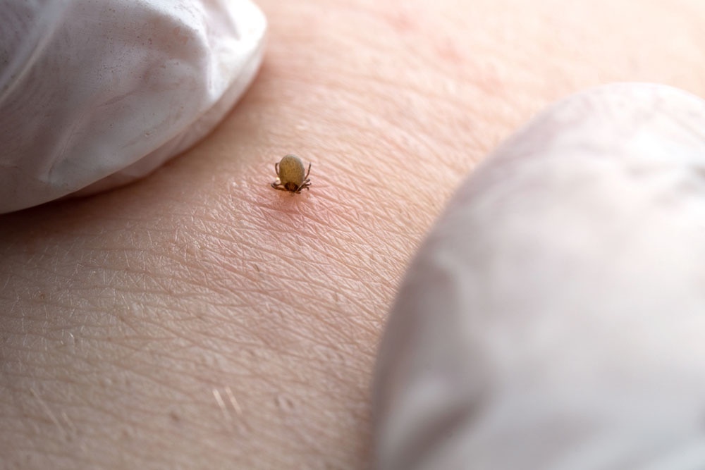 Человек пытается достать клеща.