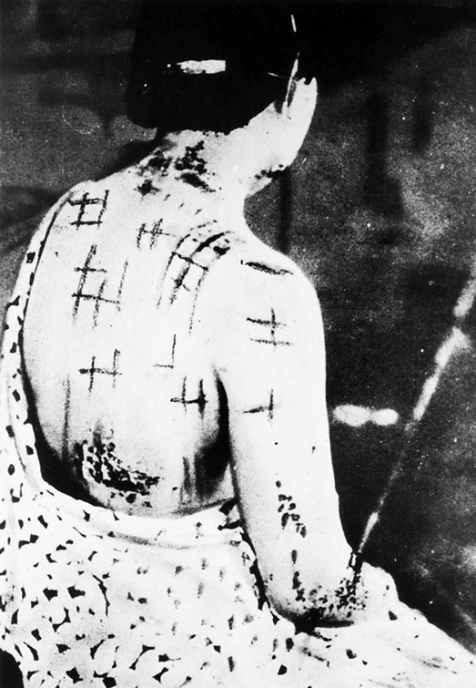Ожоги от горевшей на коже одежды. 1945
