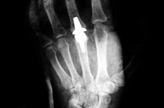 Самарские врачи впервые выполнили операцию по эндопротезированию пястно-фалангового сустава
