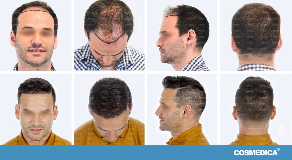 Стоимость Пересадки Волос Мужчинам