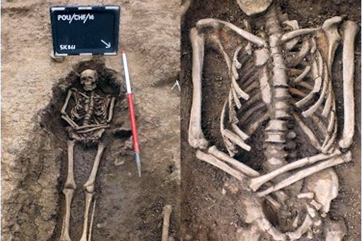 Палеопатологи пришли к выводу, что погребенный лишился кисти в результате операции. Селянин выжил после этого и долгое время продолжал пользоваться рукой. Палеопатологи пришли к выводу, что погребенный лишился кисти в результате операции. Селянин выжил после этого и долгое время продолжал пользоваться рукой.
