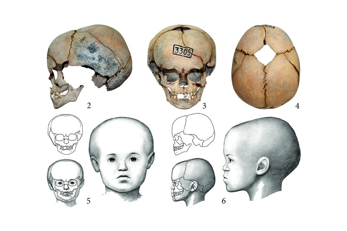 Малыш прожил от 16 до 32 месяцев и отличался большой черепной коробкой и открытым родничком, что указывает на макроцефалию. Малыш прожил от 16 до 32 месяцев и отличался большой черепной коробкой и открытым родничком, что указывает на макроцефалию.