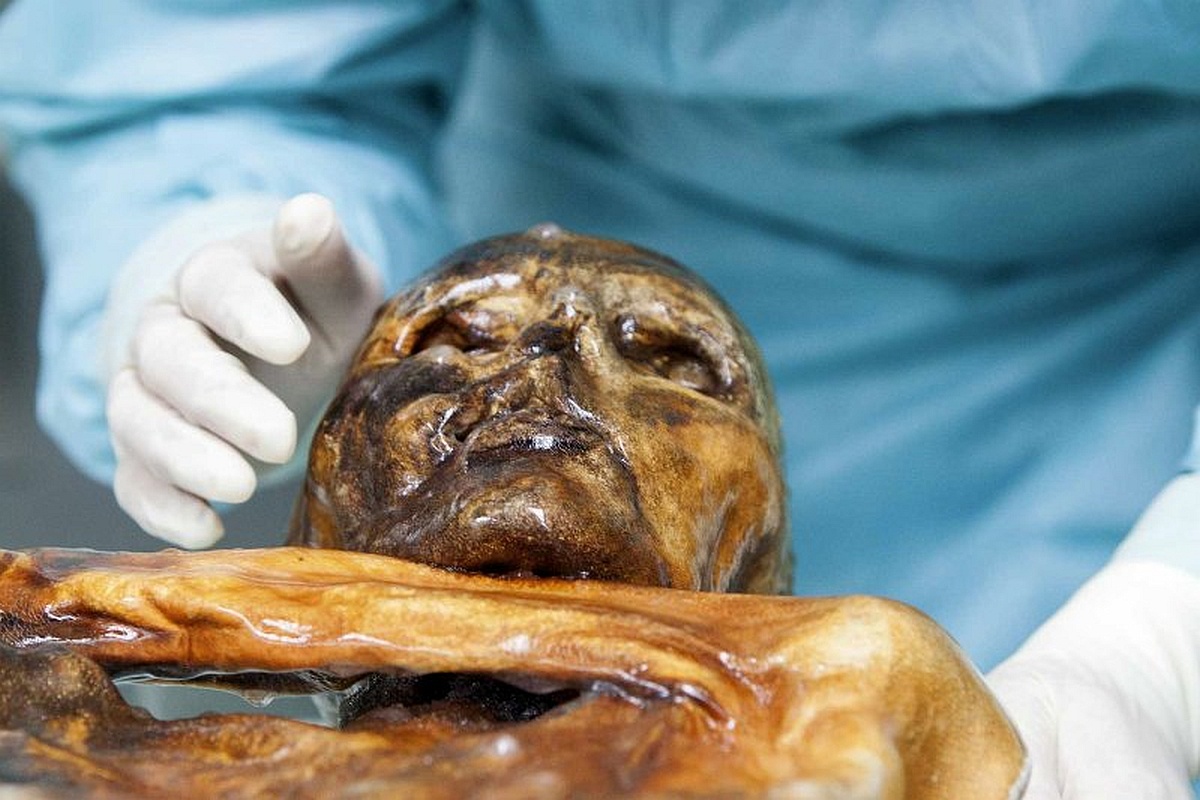 К обнаруженным у Этци болезням прибавился еще и вирус.