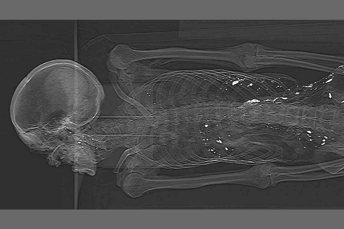 Ртуть и киноварь в средневековом Китае часто связывали с идеями продления жизни и даже бессмертия. Присутствие этих веществ в теле и кишечнике подтверждают белые пятна на рентгене.