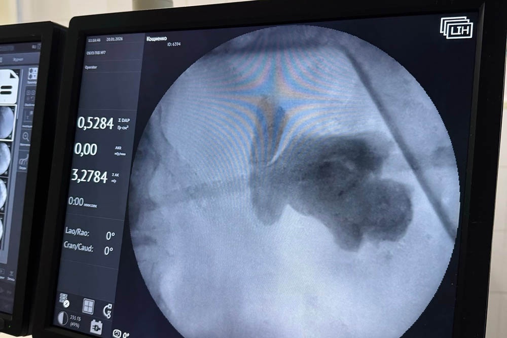 Камень занимал всю почку, а один из обломков заблокировал отток. Это могло привести к трагедии.